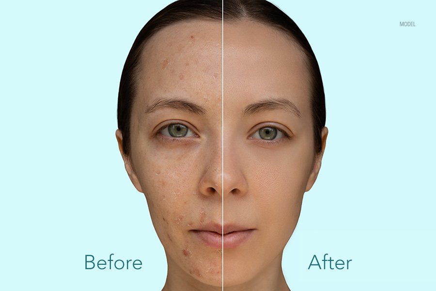 Chemical Peel