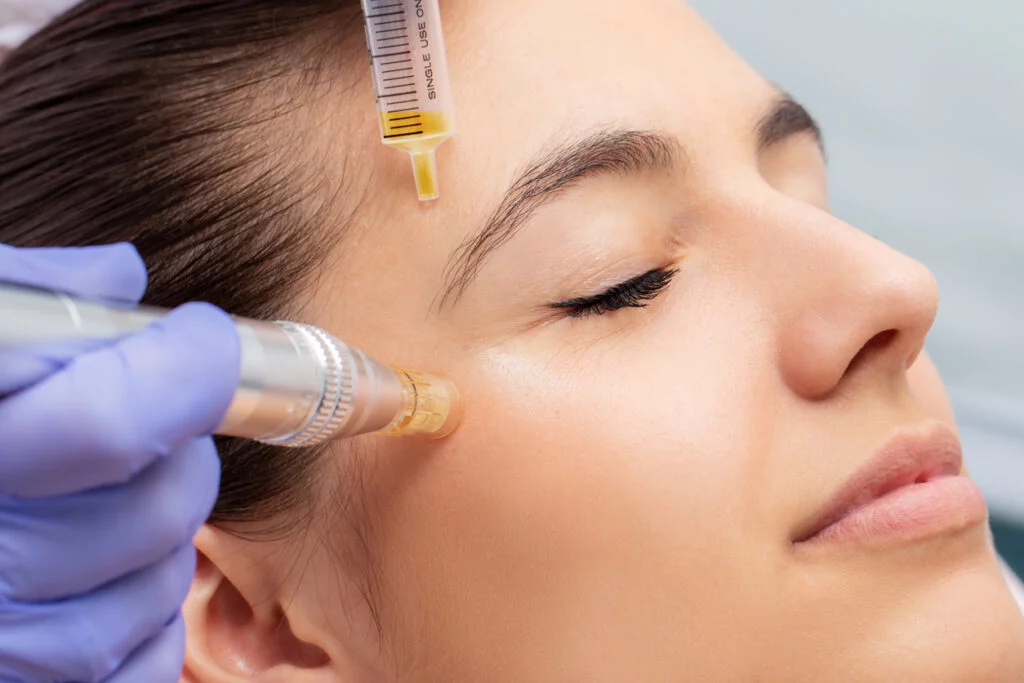 PRP Treatment